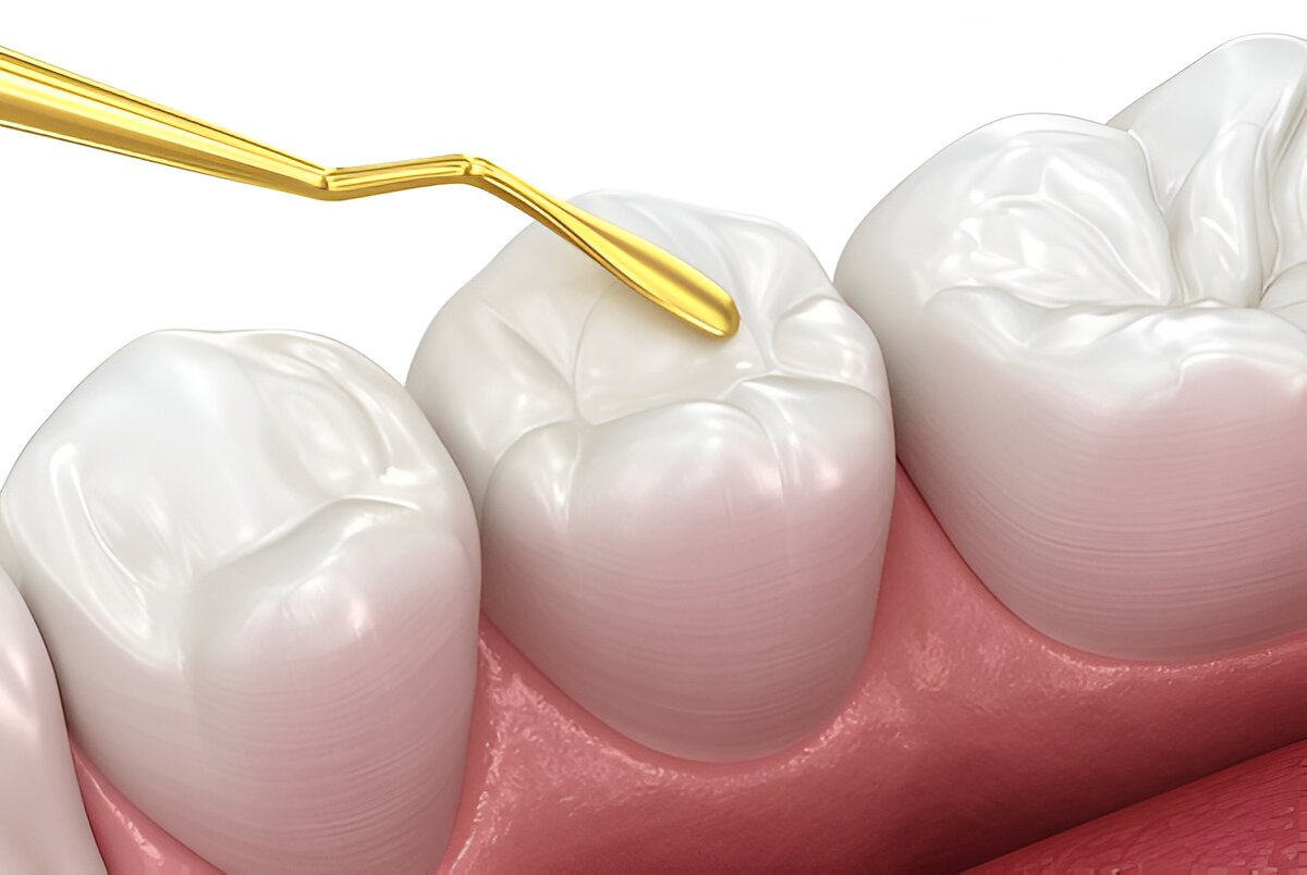 composite-fillings-hamilton