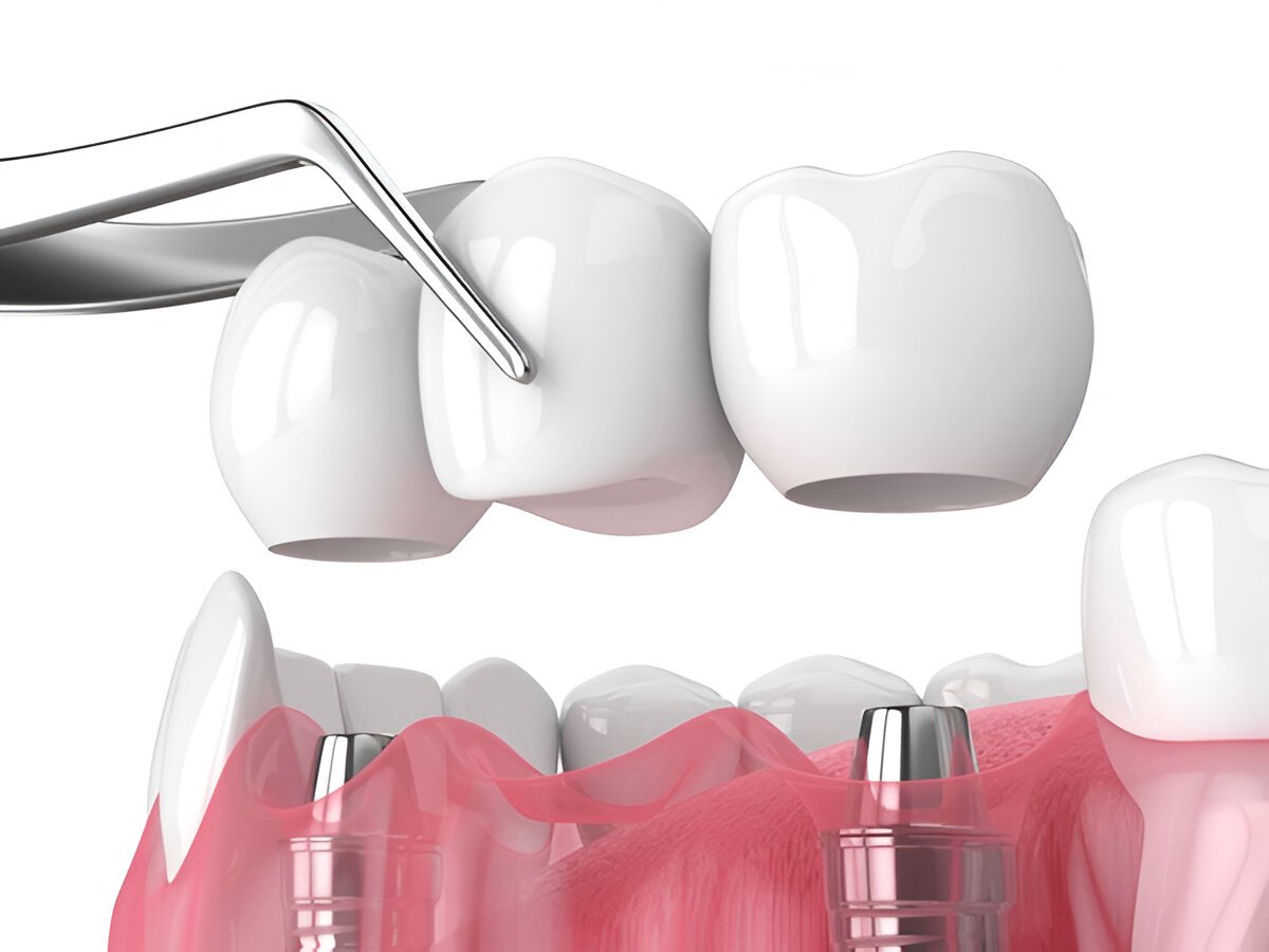 dental bridges hamilton