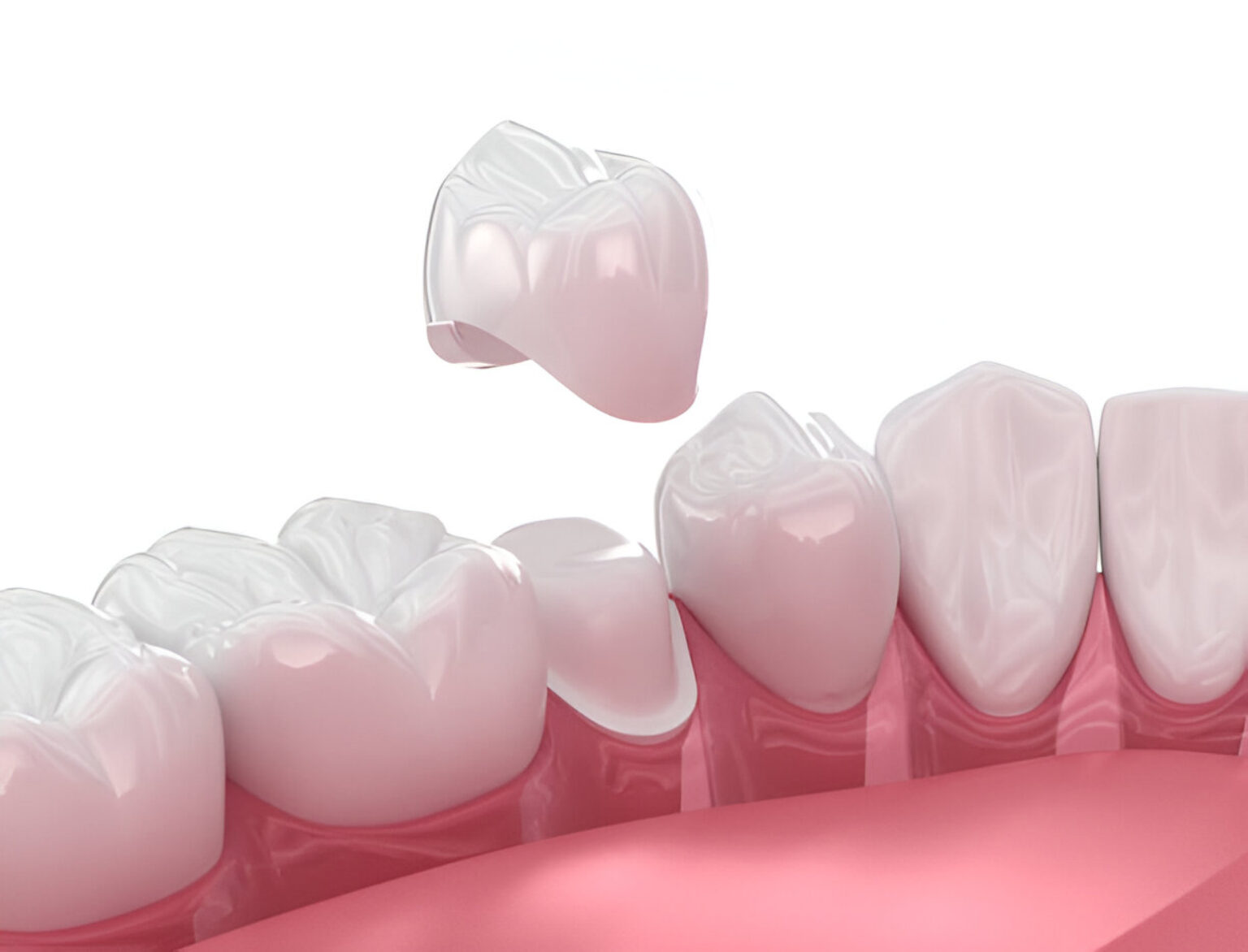 dental crowns hamilton