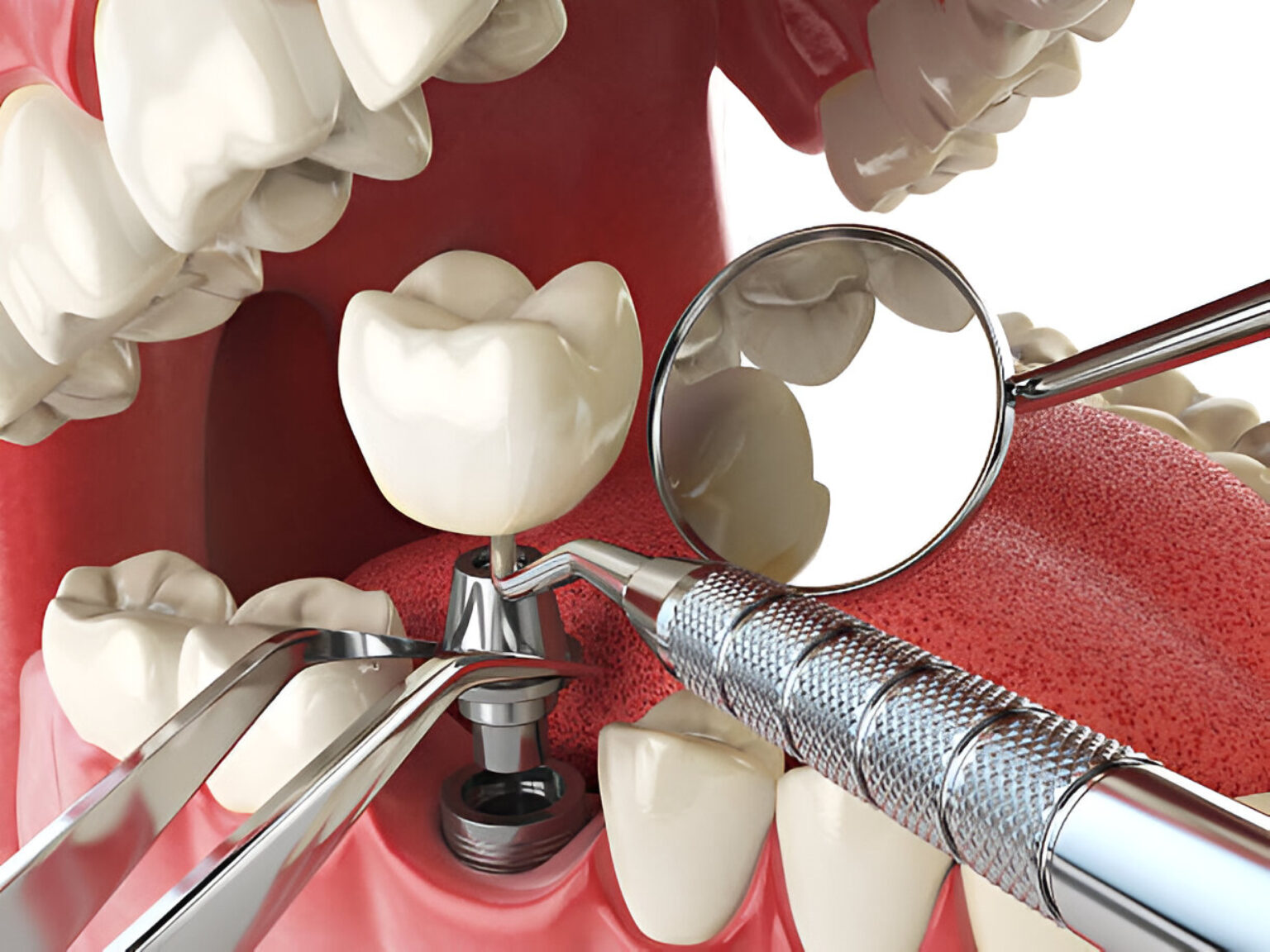 dental implants hamilton