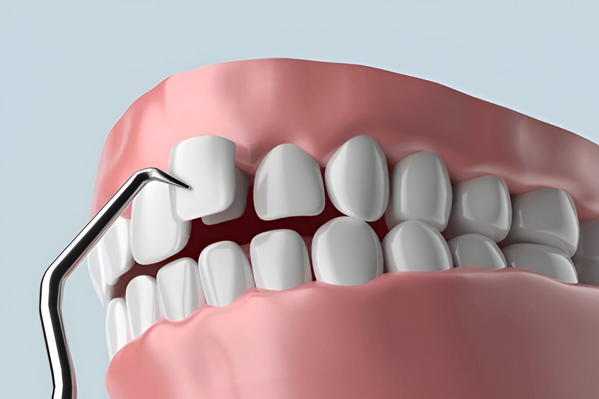 dental veneers hamilton