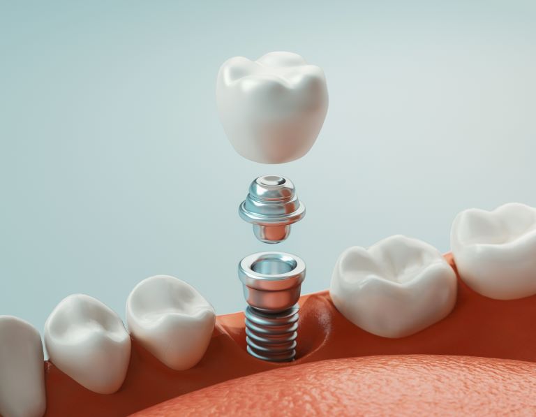 dental impants in hamilton