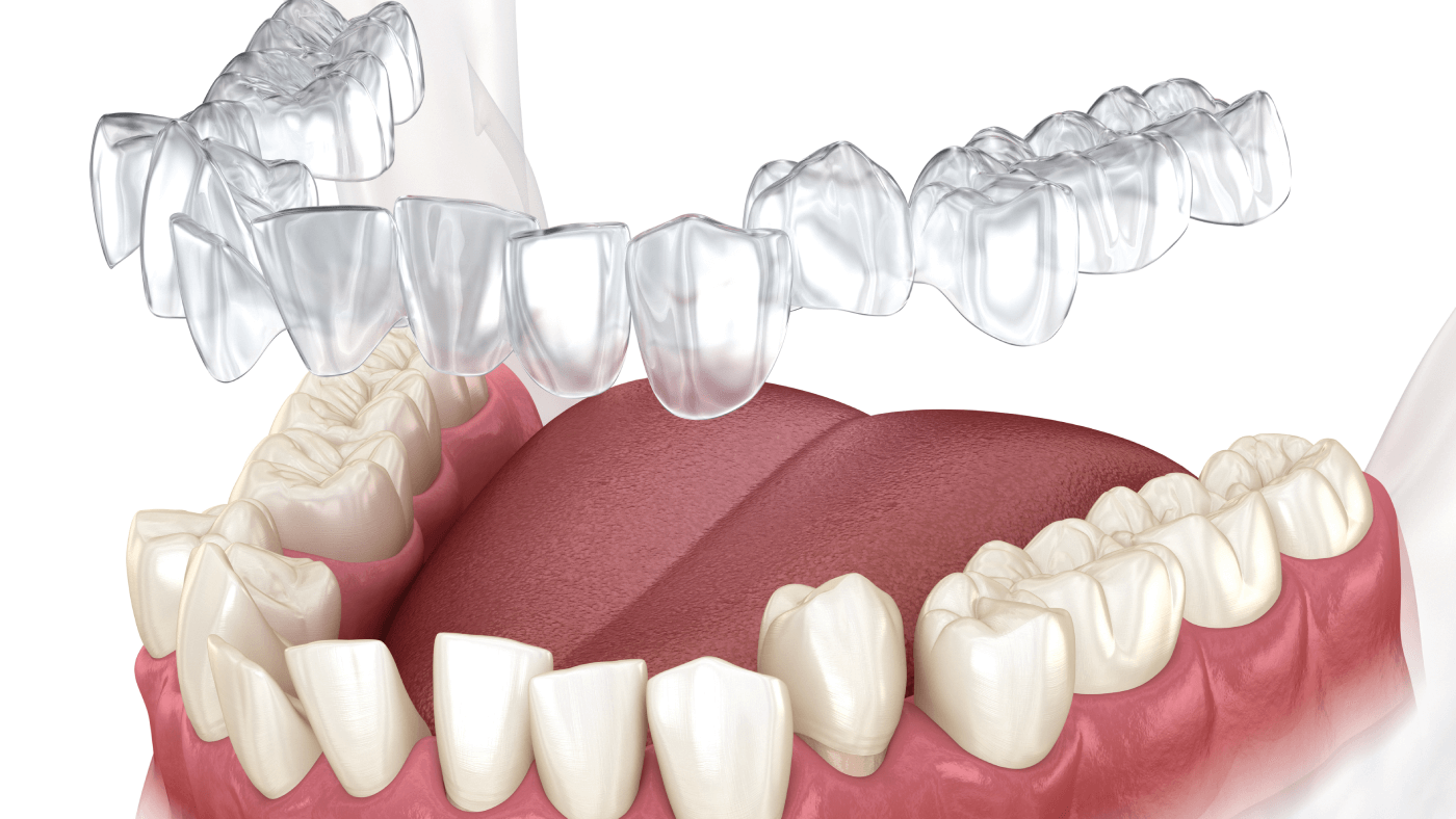 invisalign in hamilton
