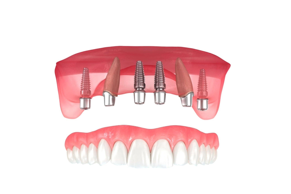 top 7 benefits of choosing dental implants