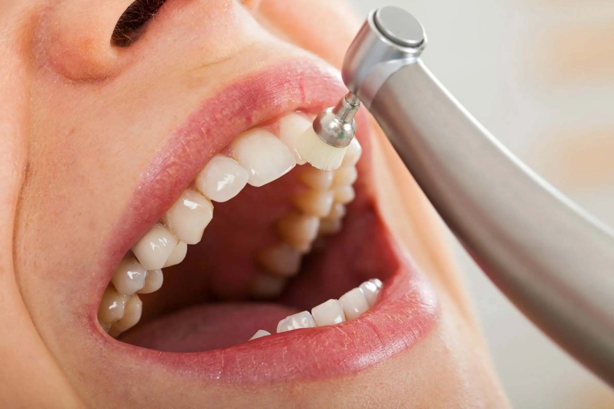 what is dental cleaning
