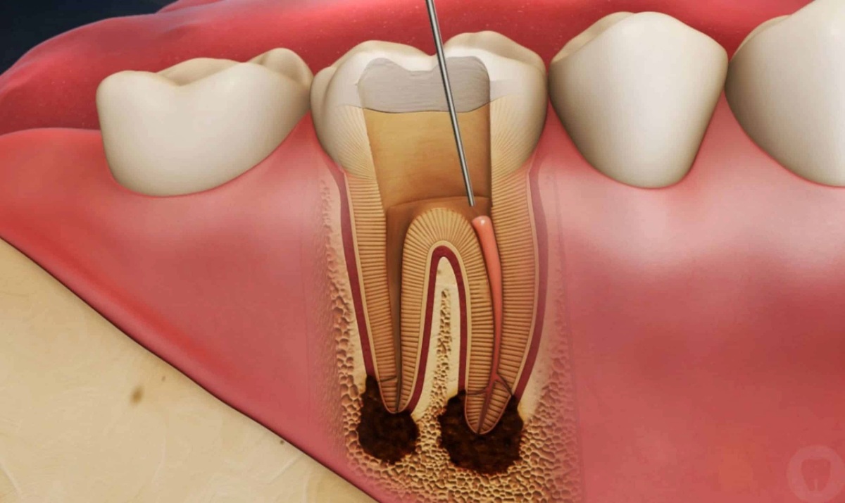 what is root canal treatment and benefits root canal treatment