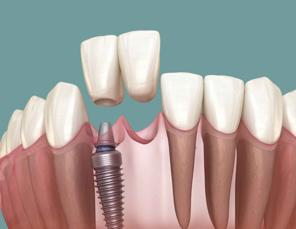 dental implants cost in hamilton