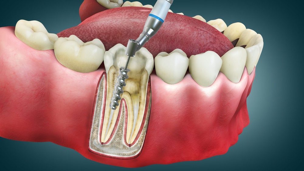 Is root canal treatment included in the canadian dental care plan