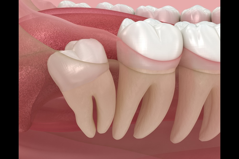 what are the different types of wisdom teeth extraction and the cost of teeth extraction