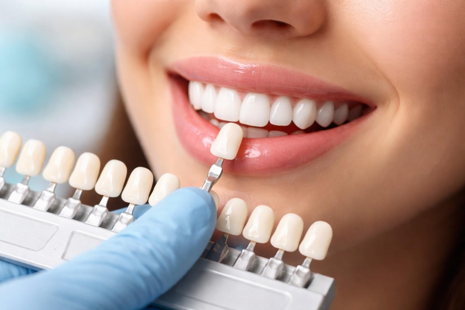 How long do dental veneers last are veneers bad for Your teeth